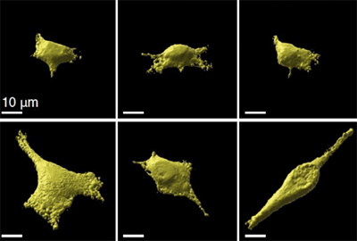 In the top row, tumour cells are small, in the bottom row, tumour cells have expanded and are misshaped.